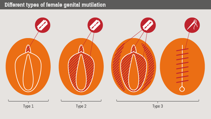 Image result for fgm procedures pictures